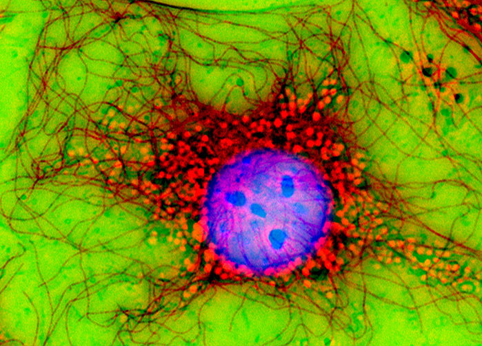 áttétes rákos sejtek hol vannak a nemi szemölcsök