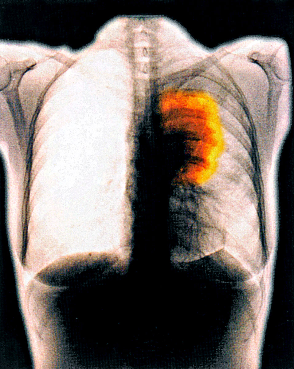 Tüdőrákos beteg röntgenképe