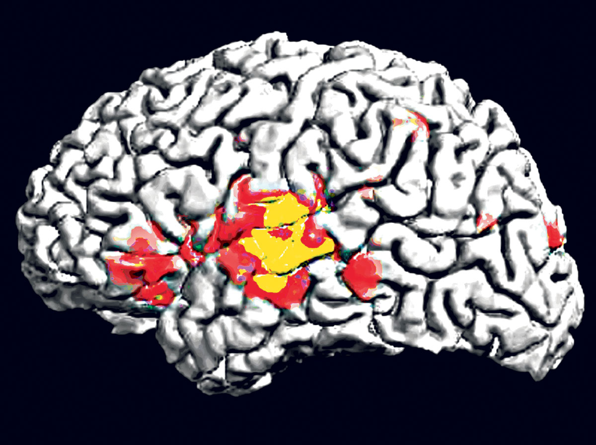 Aktivitás az agyban a funkcionális MRI képén