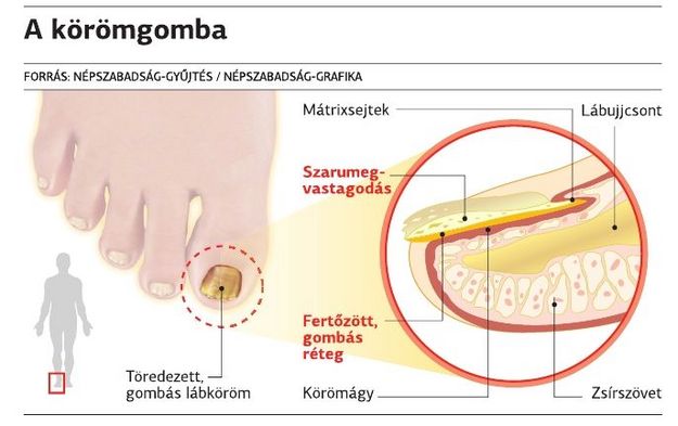 Milyen veszélyt jelent a gombás fertőzés ⋆ Körömgomba kezelése