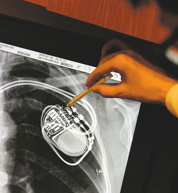 MRI álló pacemaker