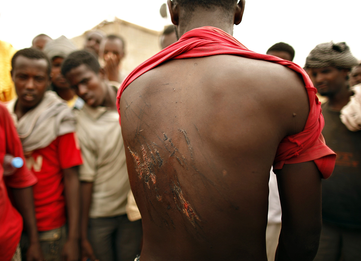 Kínzás nyomai egy etióp menekült hátán. Alábecsülik a rabszolgák számát