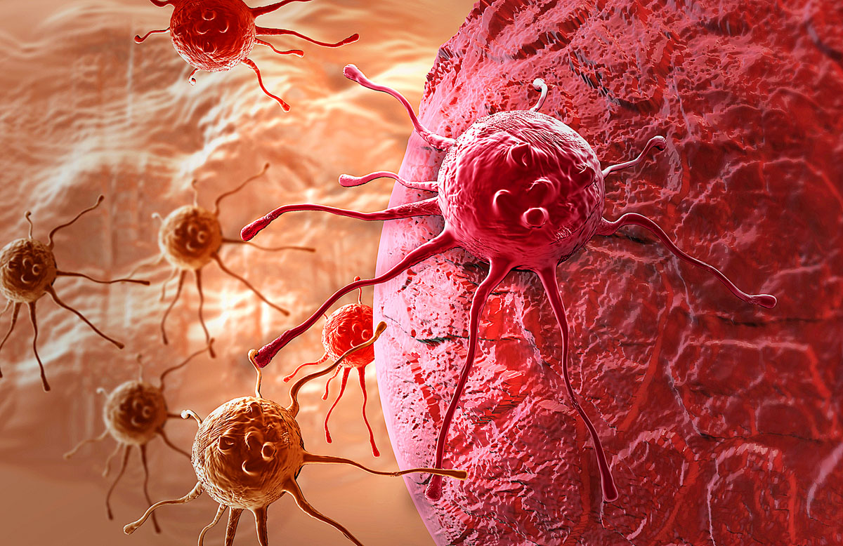 Átalakított immunsejtek támadják a daganatot (fantáziakép)