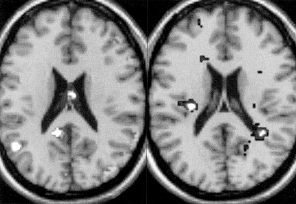 A nõk (balra) és a férfiak (jobbra) agyában más területeken aktiválódnak a szexhormonok (MRI-felvétel)