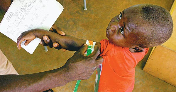 Alultáplált kongói kisgyerek karját méri meg egy segélyszervezet orvosa 
