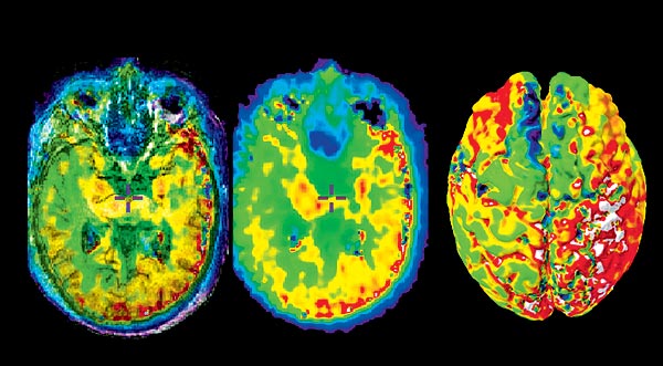Alzheimeres folyamat előrehaladása az agyban MRI-felvételeken
