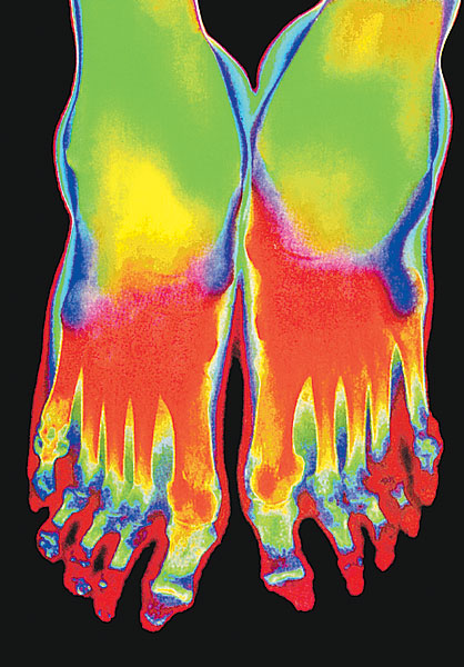 Arthritises lábfej mágneses rezonanciás eljárással készült felvételen