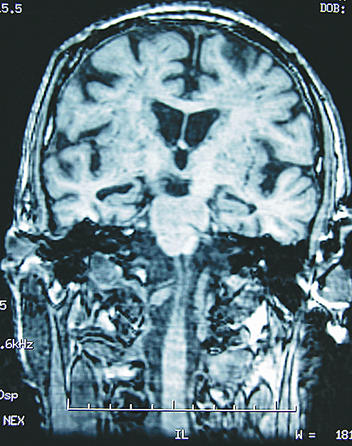 Alzheimeres agy MR-felvételen