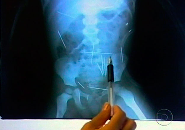 A kisfiú testéről készült röntgenképen jól látszanak a tűk