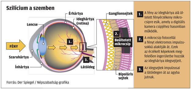 myopia és hyperopia teszt hogyan lehet megérteni a rövidlátást