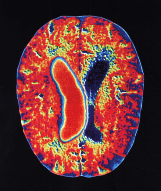 Szélütéses agy CT-felvétele