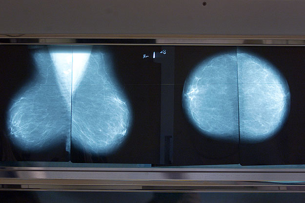 Mammográfiás felvétel