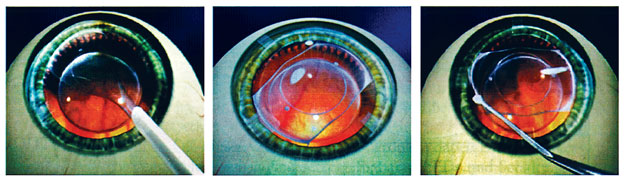 Erősen rövidlátóknak ajánlott kontaktlencse-implantátum. 1. A feltekert lencsét kis bevágás segítségével beültetik 2. A bevezetett lencse rásimul a természetes szemlencsére 3. A lencse négy sarkát a szivárványhártya alá simítják