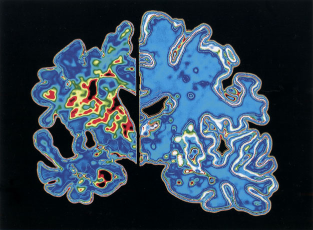 Egy Alzheimer-kóros (baloldalt) és egy egészséges agy (jobboldalt) képe MRI-felvételen