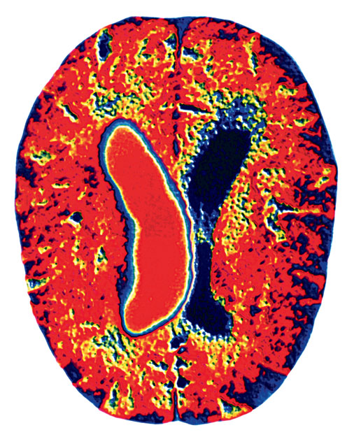 CT-felvétel egy stroke által megtámadott agyról