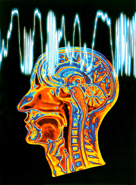 Az epilepsziás roham az agyi elektromos görbén követhető