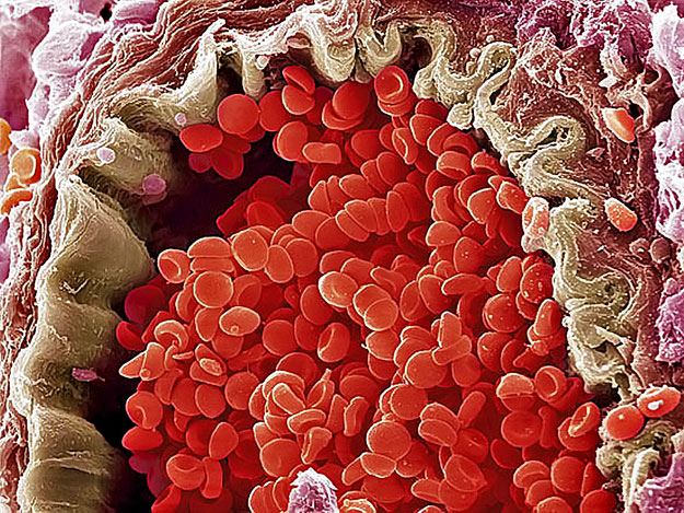Vörösvértestek az érben, melyeket (a bézs színű) endotélsejtek bélelnek. Hatnak a rákra